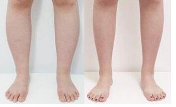 重現(xiàn)評(píng)價(jià)：北醫(yī)三院畢洪森下頜角手術(shù)效果驚艷，醫(yī)生口碑難掩其神奇魅力！