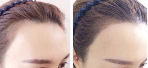 杭州疤痕整形哪家醫(yī)院好？選擇哪個醫(yī)院更靠譜？