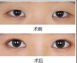 鄭州去黑點哪家醫(yī)院好？揭秘最受歡迎的黑點去除醫(yī)院