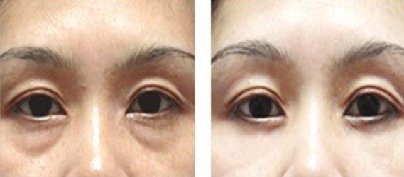 深圳哪家醫(yī)院祛色斑好-四大祛斑療法解密，選擇最適合你的祛斑方式