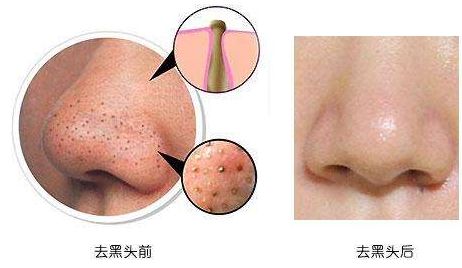 杭州哪家美容醫(yī)院吸脂效果最佳？