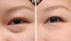 沈陽哪家醫(yī)院做脂肪隆胸效果好且價格合理？