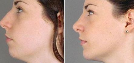 【2023邯鄲祛痘印醫(yī)院哪家好？專家推薦排行榜】