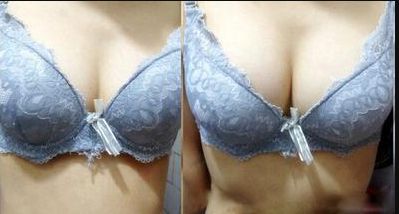 廣州哪家醫(yī)院的乳頭凹陷術(shù)效果好？