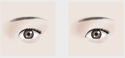 【吉林雙眼皮割的好，哪家醫(yī)院口碑最佳？】