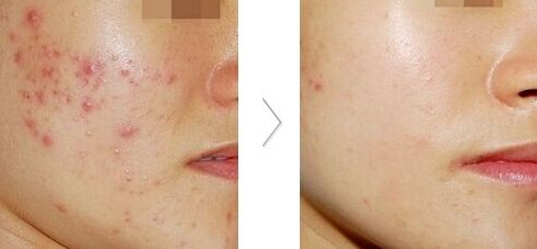 大連雙眼皮整形醫(yī)院哪家好？推薦大連哪家整形雙眼皮效果最佳