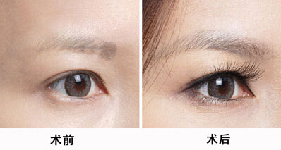 韓國(guó)醫(yī)生張柱允的顴骨磨骨技術(shù)整容潮流。