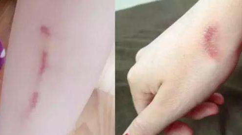 邵陽去痘去斑哪家醫(yī)院好？選擇正規(guī)醫(yī)療機(jī)構(gòu)，解決邵陽去痘去斑問題