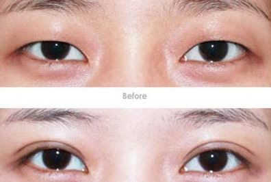 杭州開眼角醫(yī)生哪家好？專家推薦的杭州開眼角醫(yī)院排行榜