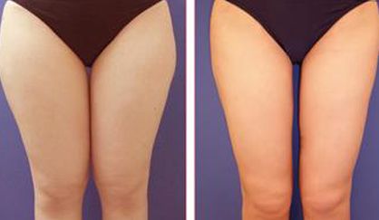 杭州去除雀斑哪家醫(yī)院好？天堂醫(yī)美專業(yè)美容師傾情解答！