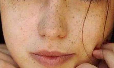 重慶當(dāng)代整形美容醫(yī)院吳玉娟祛痘嫩膚效果如何