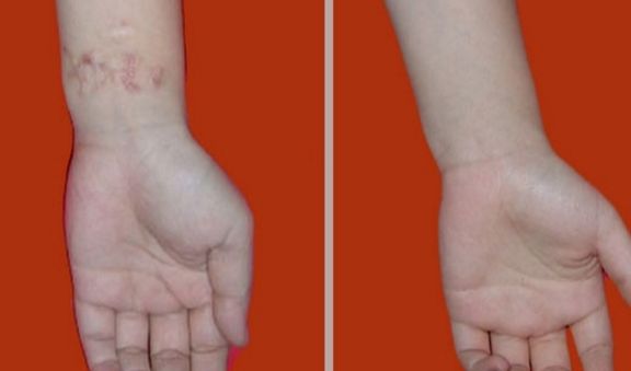 長(zhǎng)沙激光祛痘哪家醫(yī)院好？專業(yè)醫(yī)院推薦及治療經(jīng)驗(yàn)分享