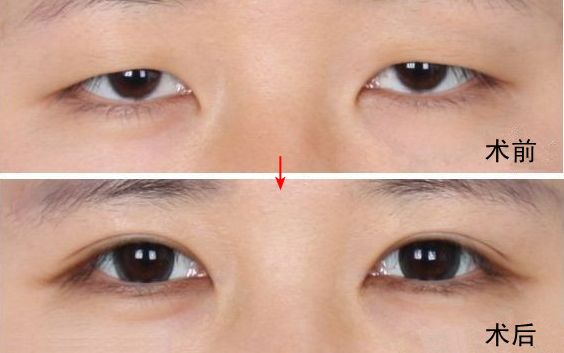 南京哪家醫(yī)院去眼袋好？眼袋手術(shù)選哪家醫(yī)院最好