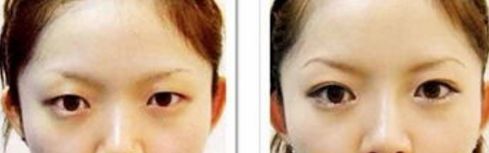 深圳眼袋手術(shù)哪家醫(yī)院最靠譜？