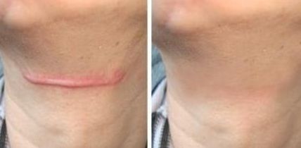 廣州哪家醫(yī)院植皮術(shù)效果好、專業(yè)的醫(yī)院推薦