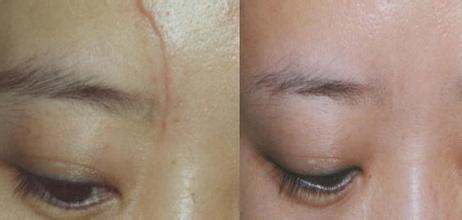 2023西寧去除額頭紋在榜單前10強專家(齊曉明、李靜、鄧小龍圈內(nèi)大拿)