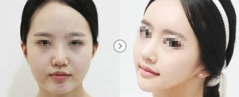 溫州哪家醫(yī)院祛除疤痕效果最佳，專家推薦！