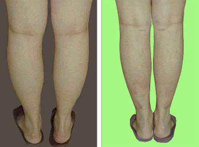 2023石家莊激光祛動態(tài)細紋權(quán)威專家評價前10強(閆琨、李香梅、何曉雅助力變美！)