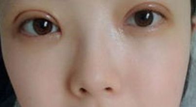 上海哪家醫(yī)院的雙眼皮手術(shù)效果最好？