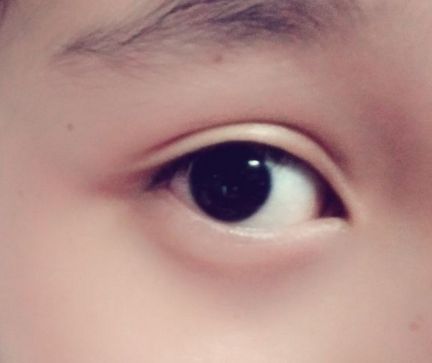 上饒祛眼袋哪家醫(yī)院好？解析上饒地區(qū)的眼袋整形醫(yī)院排名及選擇標準