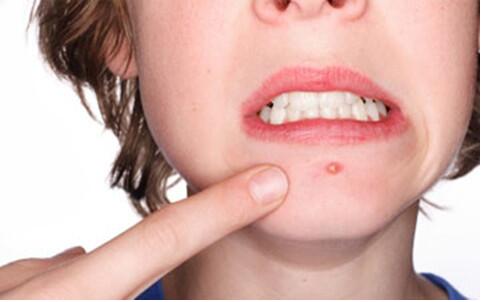 華中地區(qū)整形美容醫(yī)院張婷醫(yī)師的胎記祛除技巧跨越行業(yè)高度，備受贊譽(yù)！