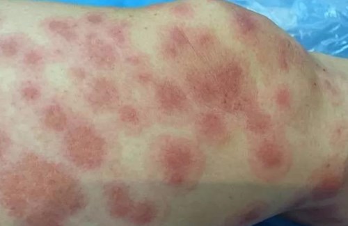 杜太超的鼻部整形效果驚艷，細(xì)節(jié)設(shè)計(jì)精湛！或杜太超的鼻子整形術(shù)成功塑造出迷人的面容