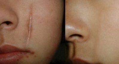 蘭州眼部修復(fù)手術(shù)哪家好？眼部整形專家為您推薦最佳選擇！