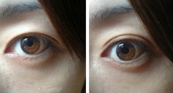 北京開眼角好的醫(yī)院有哪些？