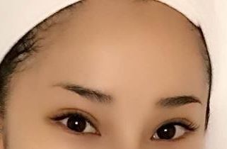 上海醫(yī)院最好治療皮膚疤痕的?？剖悄募遥?/>
                                </a>
                                <h4><a href=