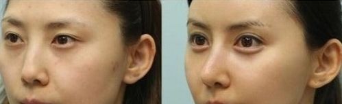 探尋上海玻尿酸隆鼻哪家好？選擇最優(yōu)質(zhì)的上海玻尿酸隆鼻機構(gòu)