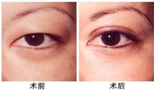 杭州做激光眼科手術哪家醫(yī)院好，專家推薦