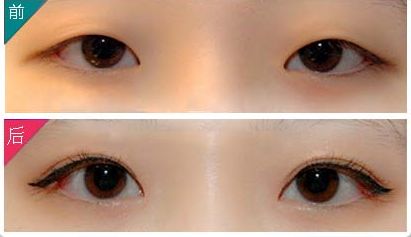 廣州哪家醫(yī)院祛眼袋效果好，專業(yè)的眼袋整形醫(yī)院推薦