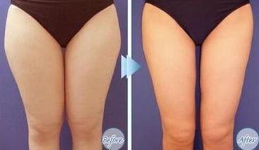 上海光澤醫(yī)院熱瑪吉效果如何？?jī)r(jià)格是多少？搭配醫(yī)生介紹一起了解