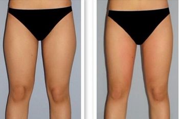 南昌哪家全科醫(yī)院有最好的外切眼袋手術(shù)效果？