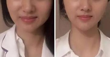 杭州激光祛斑好嗎？哪家激光祛斑的效果好？