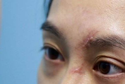 成都哪家醫(yī)院的脂肪填充臉效果好且安全？