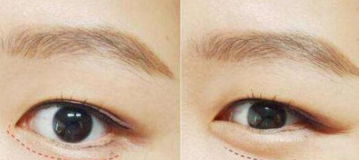 增美天使沈正宇教你打造完美鼻梁！深度揭秘示范案例，秀出新顏！