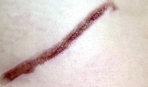 鐳射溶脂杭州哪家醫(yī)院好？專家推薦排名前三的權威醫(yī)院