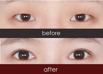 2023泉州抽脂埋線雙眼皮醫(yī)生排名榜前十名(劉劍、李迫達、王偉韜值得選擇！)