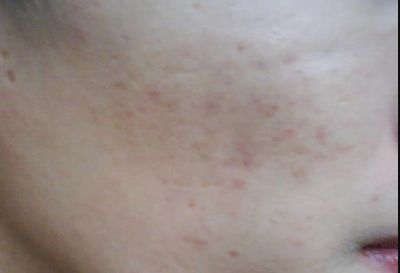 寧波祛疤哪家醫(yī)院哪里好？專家告訴你最佳選擇！