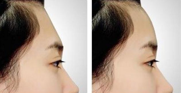 南京割雙眼皮哪家醫(yī)院效果好？