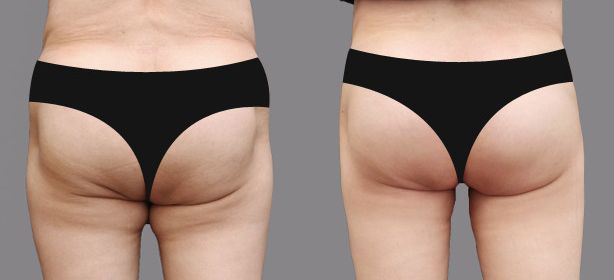 上海吸脂豐胸醫(yī)院哪家好？選擇最值得信賴的上海豐胸整形醫(yī)院