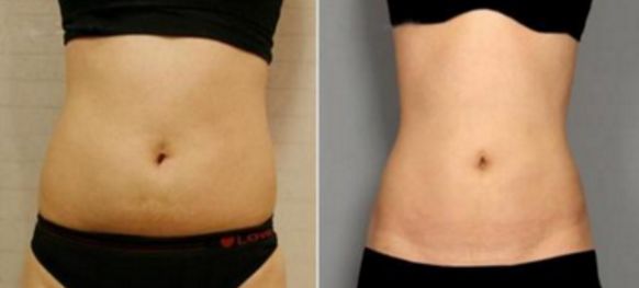 武漢玻尿酸填充效果怎么樣？哪家醫(yī)院值得選擇？