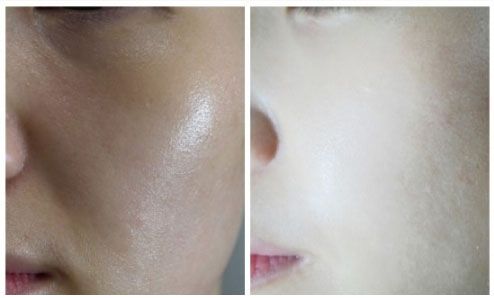 秦皇島祛斑哪家醫(yī)院好？推薦秦皇島哪家醫(yī)院祛斑效果好