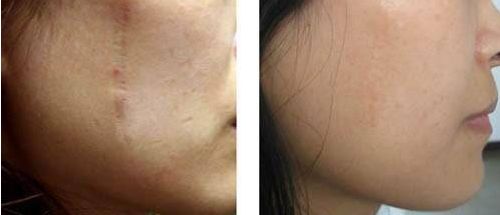 廣州抽脂手術哪家醫(yī)院最靠譜？