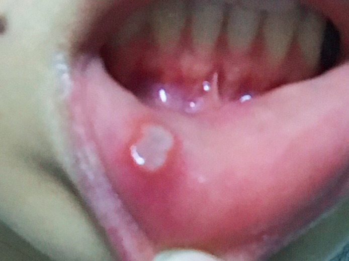 2023南昌激光鐳射祛雀斑正規(guī)專家評價前10位(胡秀龍、胡建、滿雪評價值得看)