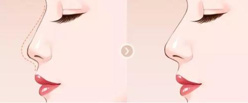 北京清木李楠演繹雙眼皮效果如何