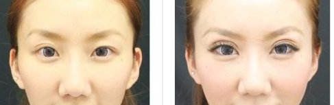 株洲哪家醫(yī)院做雙眼皮好？選擇醫(yī)院要注意這幾個關鍵點！