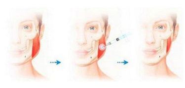 南京假體隆鼻哪家醫(yī)院效果最好？