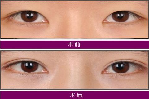 大連注射玻尿酸哪家醫(yī)院技術(shù)好，效果持久？